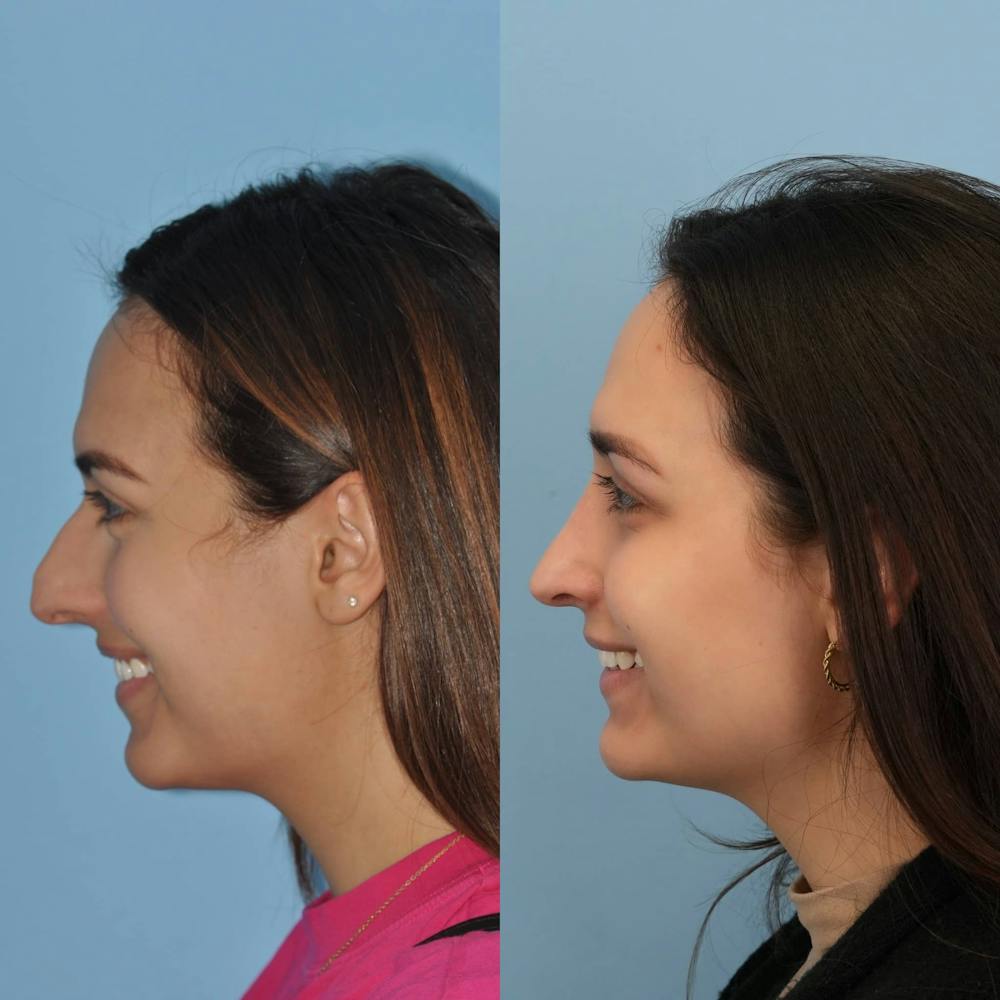 Rhinoplasty Before & After Gallery - Patient 201850 - Image 4
