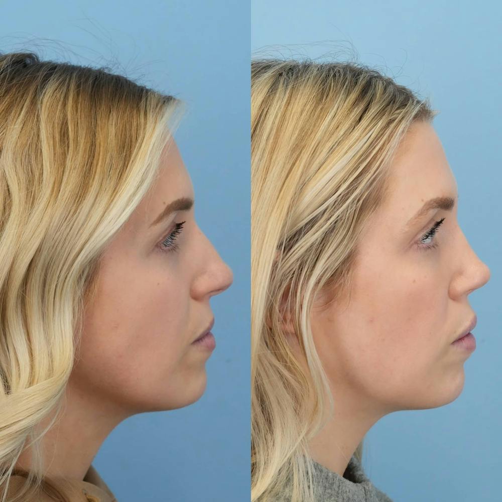 Rhinoplasty Before & After Gallery - Patient 272112 - Image 3