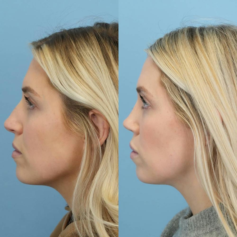 Rhinoplasty Before & After Gallery - Patient 272112 - Image 6