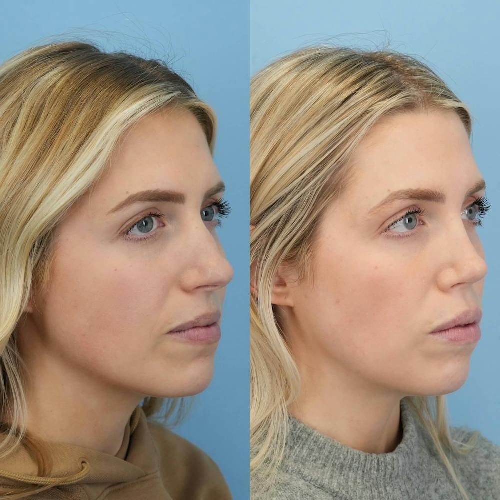 Rhinoplasty Before & After Gallery - Patient 272112 - Image 4