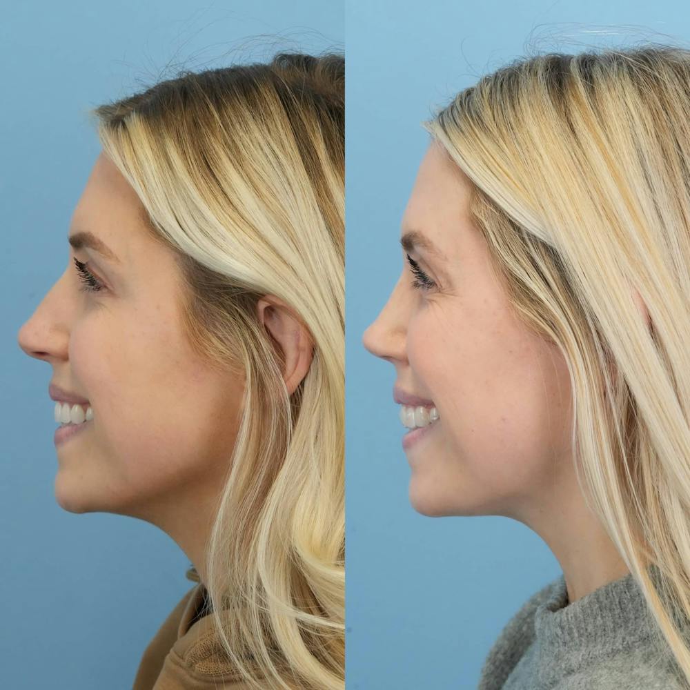 Rhinoplasty Before & After Gallery - Patient 272112 - Image 7