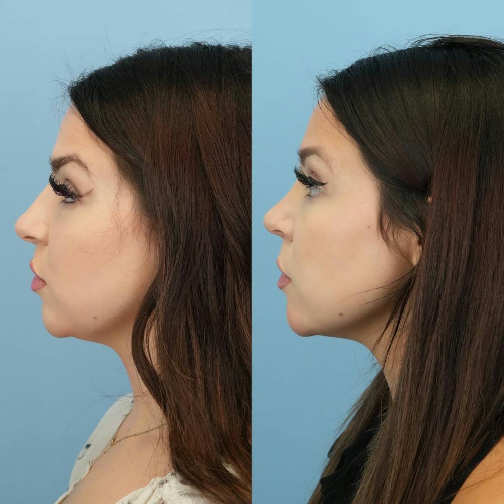 Rhinoplasty Before & After Gallery - Patient 131325 - Image 2