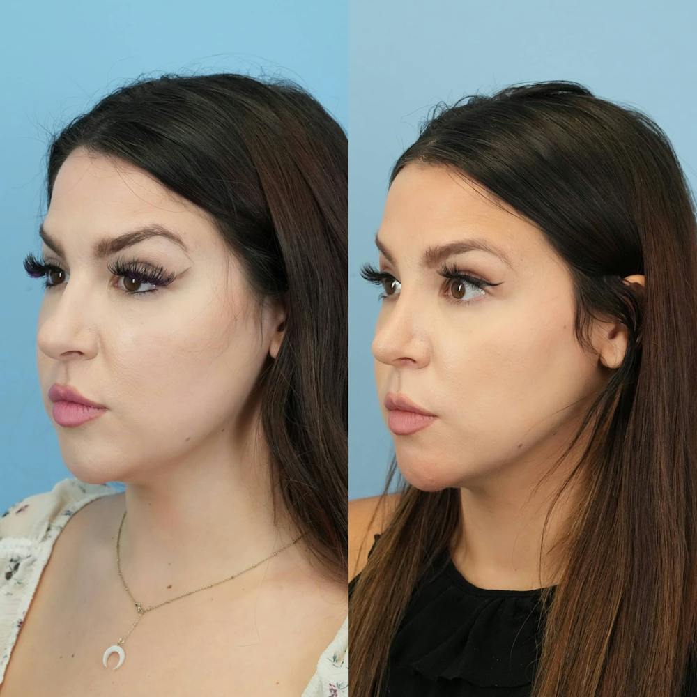 Rhinoplasty Before & After Gallery - Patient 131325 - Image 3
