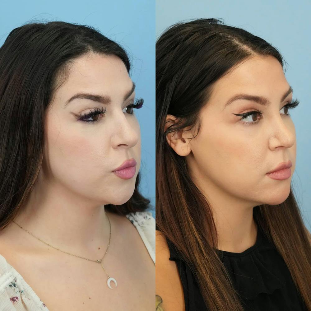 Rhinoplasty Before & After Gallery - Patient 131325 - Image 4