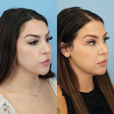 Rhinoplasty Before & After Gallery - Patient 131325 - Image 4