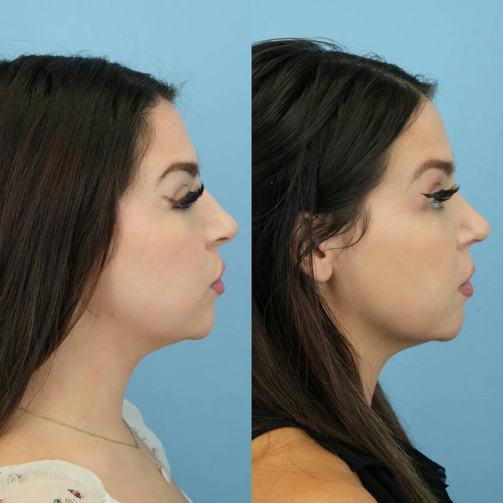 Rhinoplasty Before & After Gallery - Patient 131325 - Image 5
