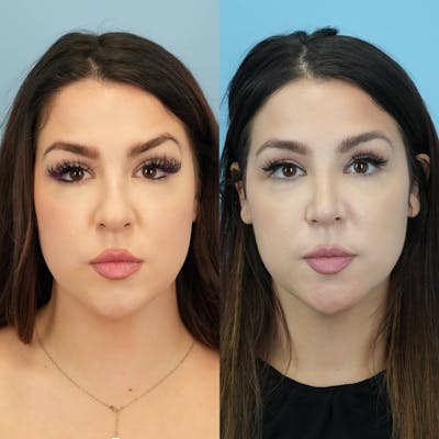 Rhinoplasty Before & After Gallery - Patient 131325 - Image 1