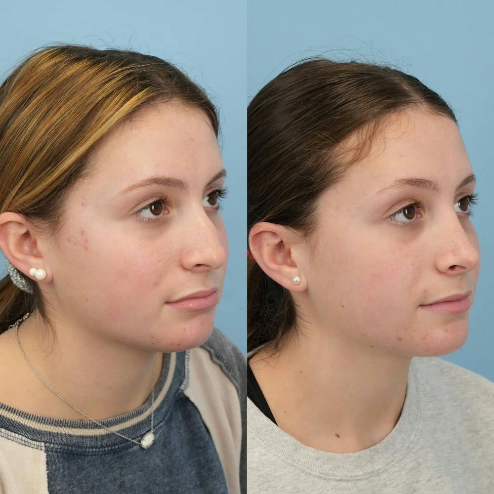 Rhinoplasty Before & After Gallery - Patient 285021 - Image 5