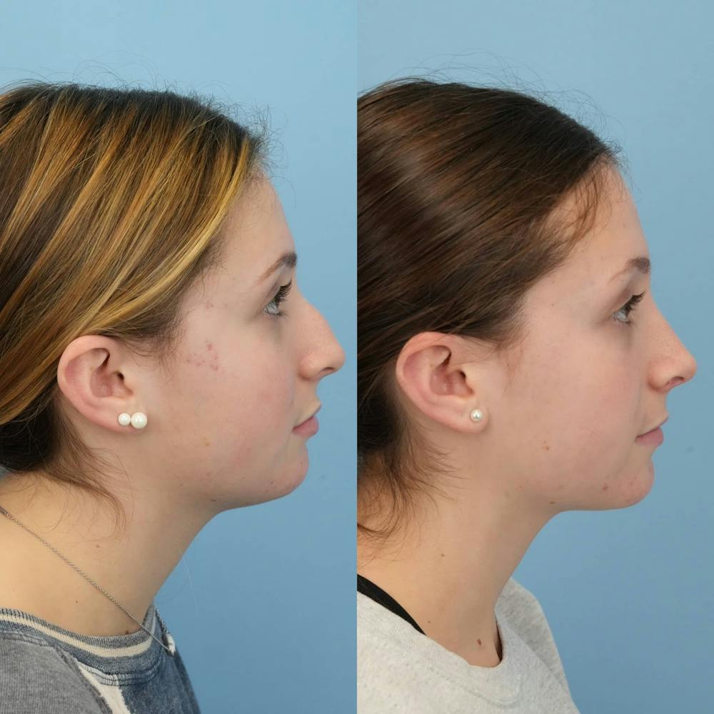 Rhinoplasty Before & After Gallery - Patient 285021 - Image 6