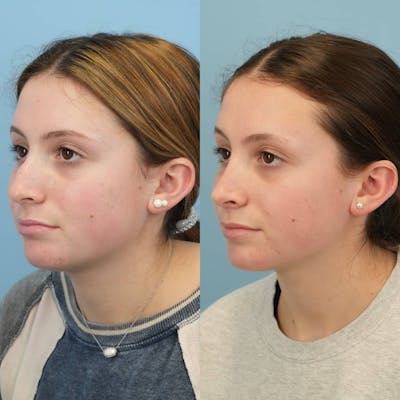 Rhinoplasty Before & After Gallery - Patient 285021 - Image 4