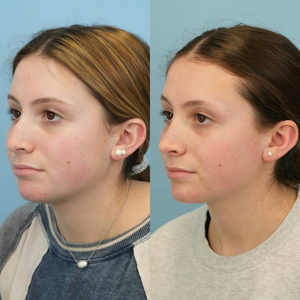 Rhinoplasty Before & After Gallery - Patient 285021 - Image 4