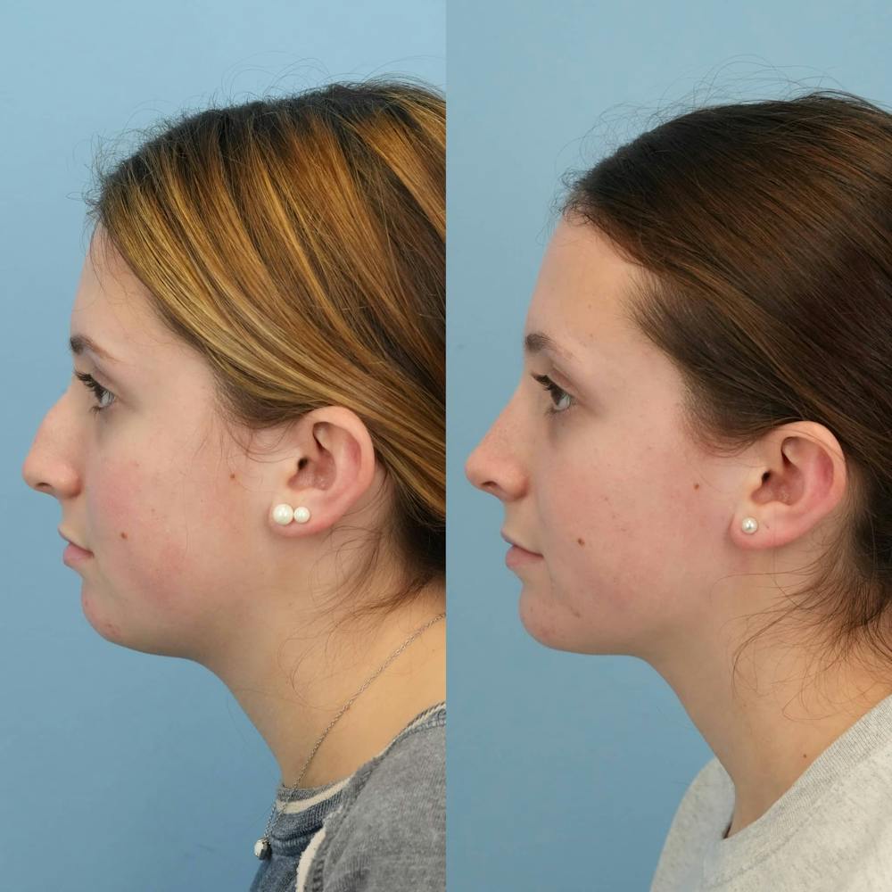 Rhinoplasty Before & After Gallery - Patient 285021 - Image 3