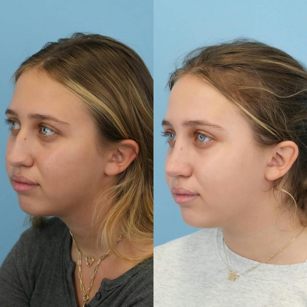 Rhinoplasty Before & After Gallery - Patient 125523 - Image 4