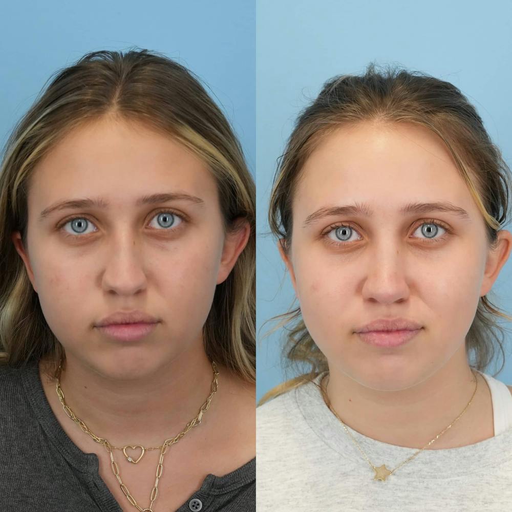 Rhinoplasty Before & After Gallery - Patient 125523 - Image 1
