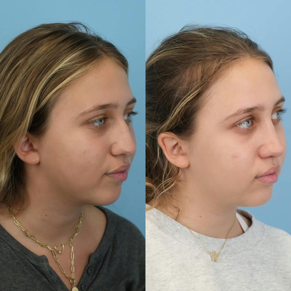 Rhinoplasty Before & After Gallery - Patient 125523 - Image 5
