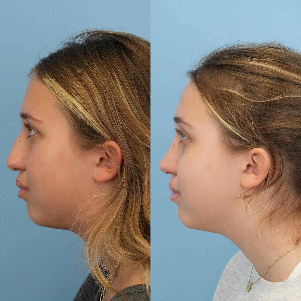 Rhinoplasty Before & After Gallery - Patient 125523 - Image 2