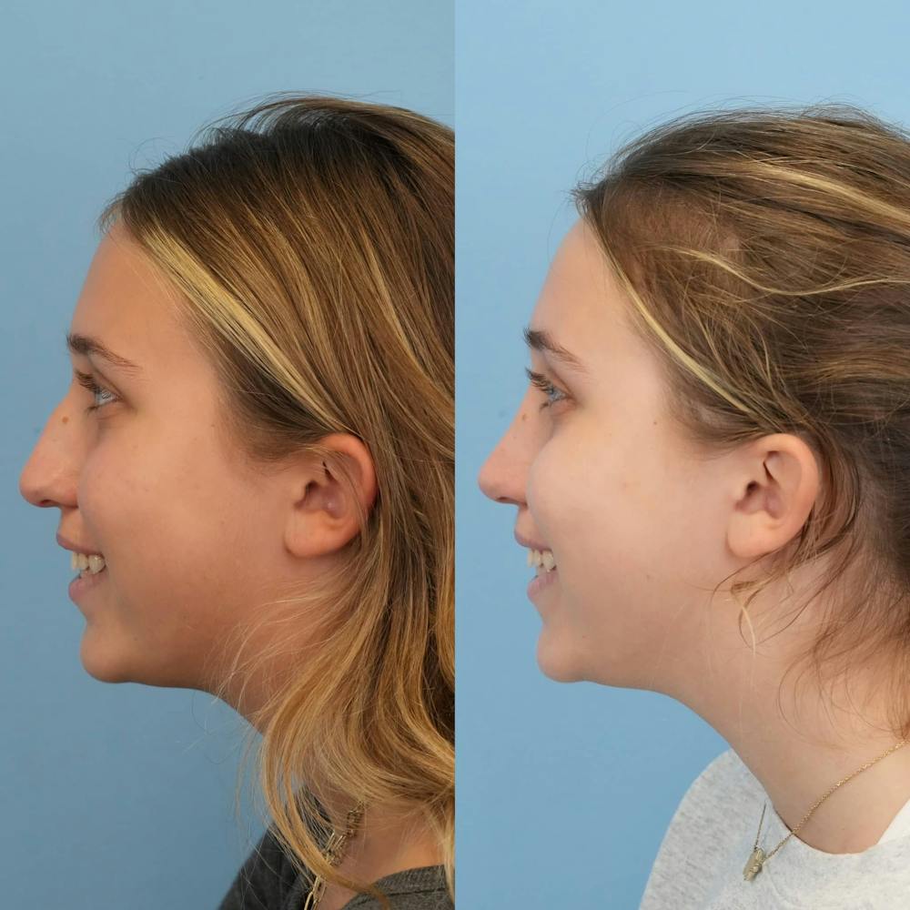 Rhinoplasty Before & After Gallery - Patient 125523 - Image 3