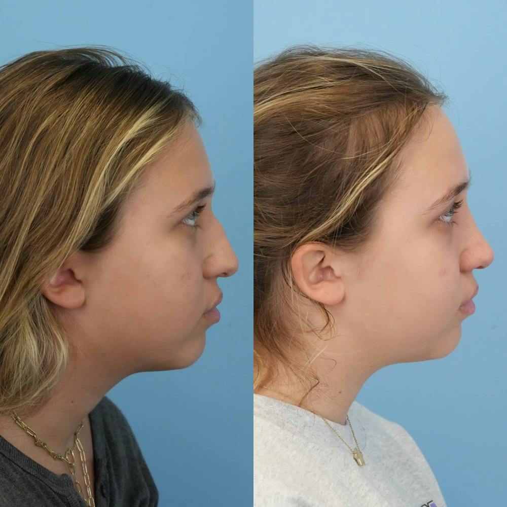 Rhinoplasty Before & After Gallery - Patient 125523 - Image 6