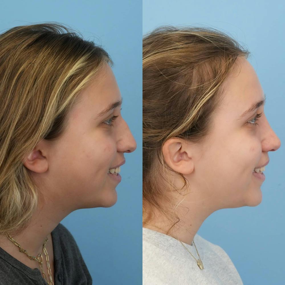 Rhinoplasty Before & After Gallery - Patient 125523 - Image 7