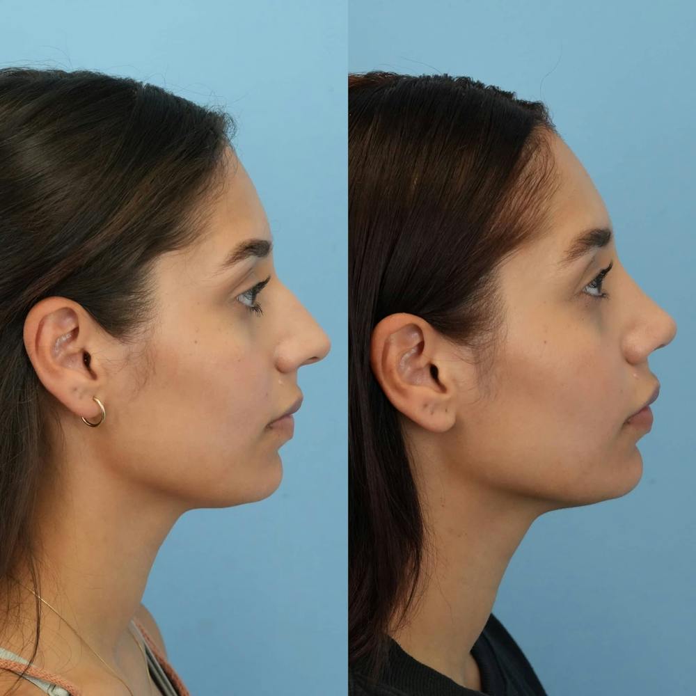 Rhinoplasty Before & After Gallery - Patient 394916 - Image 7