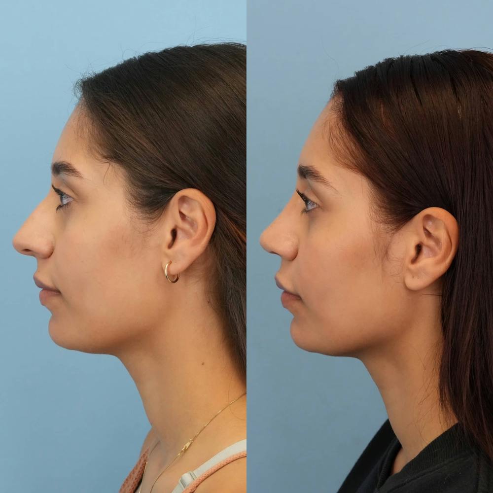 Rhinoplasty Before & After Gallery - Patient 394916 - Image 3