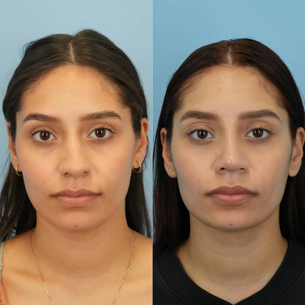 Rhinoplasty Before & After Gallery - Patient 394916 - Image 1