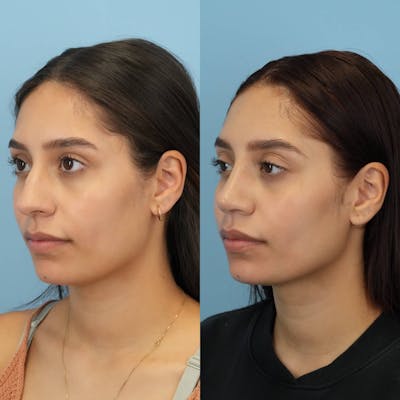 Rhinoplasty Before & After Gallery - Patient 394916 - Image 4