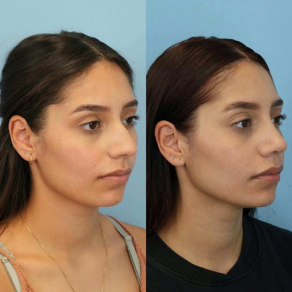 Rhinoplasty Before & After Gallery - Patient 394916 - Image 5