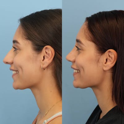 Rhinoplasty Before & After Gallery - Patient 394916 - Image 2