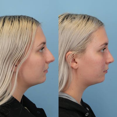 Rhinoplasty Before & After Gallery - Patient 256753 - Image 6