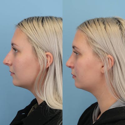 Rhinoplasty Before & After Gallery - Patient 256753 - Image 2
