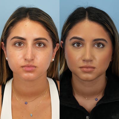 Rhinoplasty Before & After Gallery - Patient 252861 - Image 1