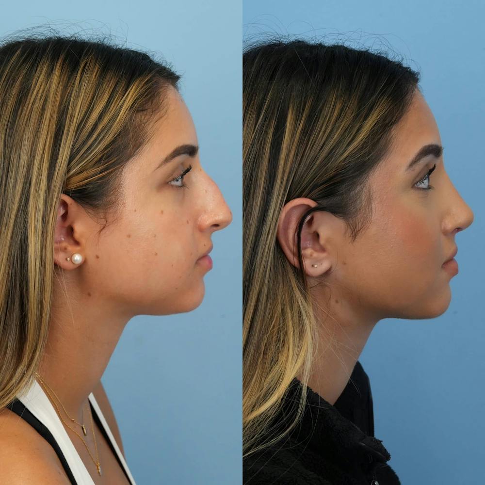 Rhinoplasty Before & After Gallery - Patient 252861 - Image 7