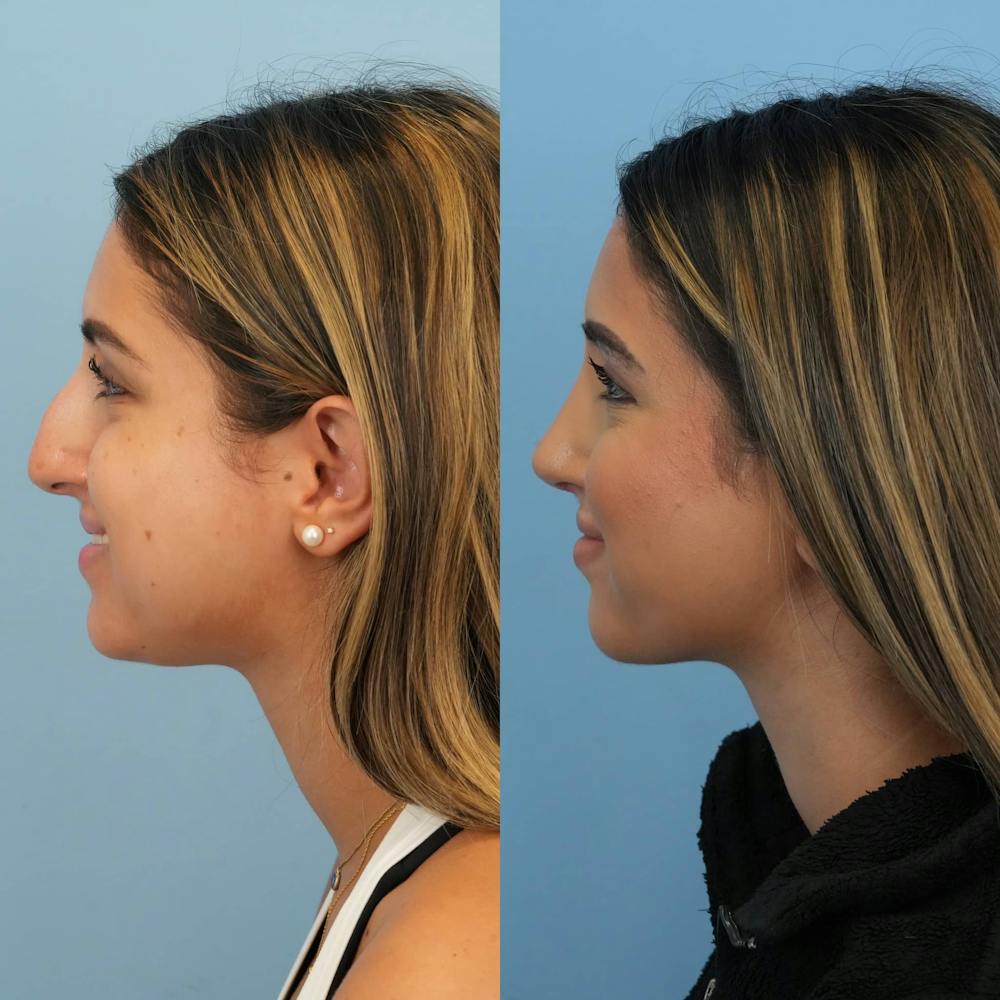 Rhinoplasty Before & After Gallery - Patient 252861 - Image 3
