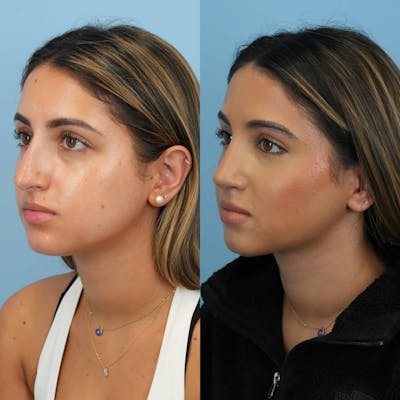 Rhinoplasty Before & After Gallery - Patient 252861 - Image 4