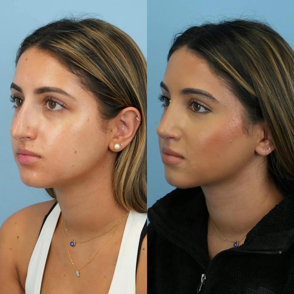 Rhinoplasty Before & After Gallery - Patient 252861 - Image 4