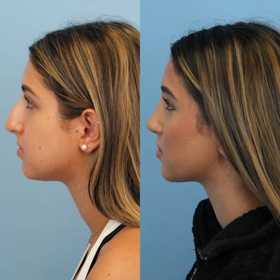 Rhinoplasty Before & After Gallery - Patient 252861 - Image 2