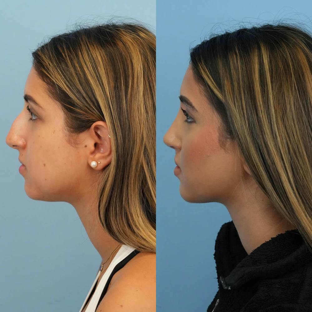 Rhinoplasty Before & After Gallery - Patient 252861 - Image 2
