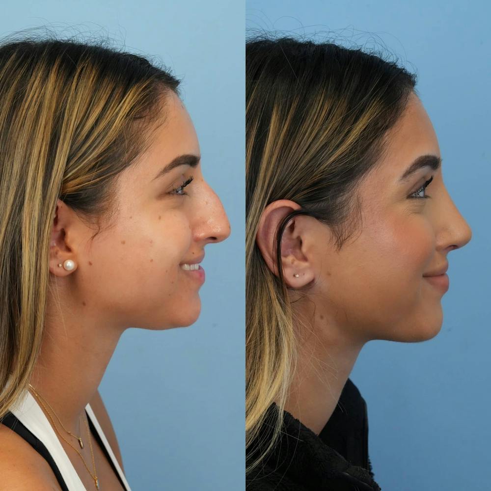 Rhinoplasty Before & After Gallery - Patient 252861 - Image 6