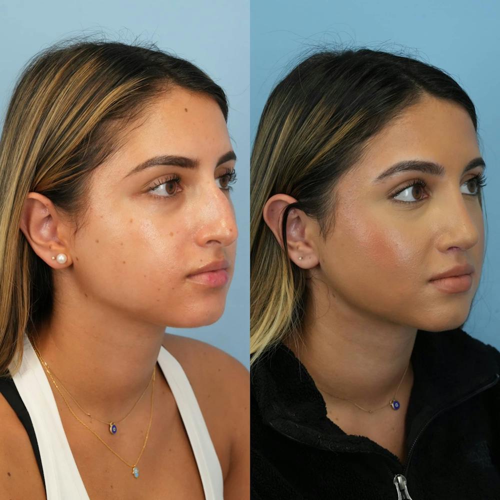 Rhinoplasty Before & After Gallery - Patient 252861 - Image 5