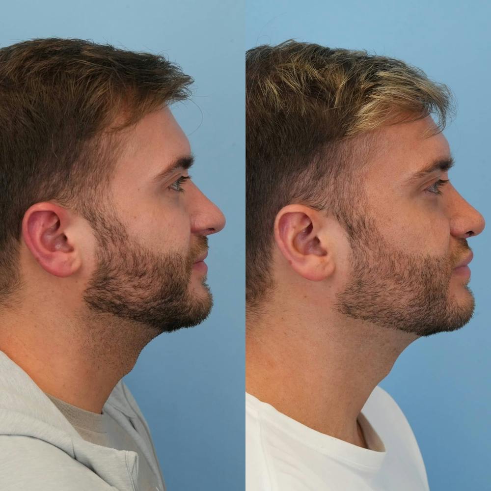 Rhinoplasty Before & After Gallery - Patient 240119 - Image 2
