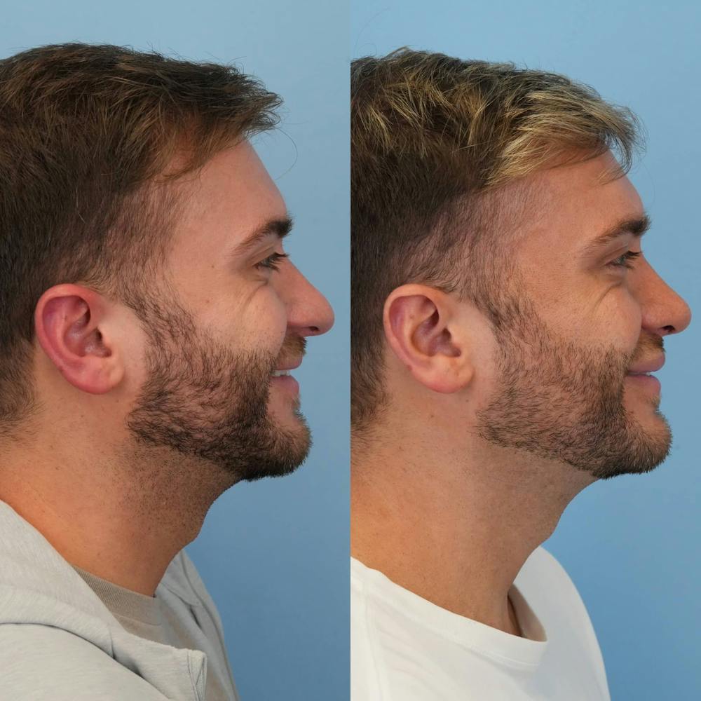 Rhinoplasty Before & After Gallery - Patient 240119 - Image 3
