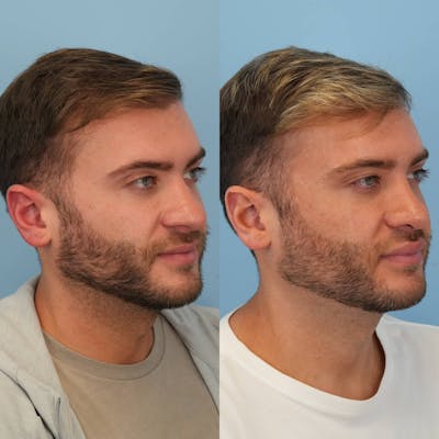 Rhinoplasty Before & After Gallery - Patient 240119 - Image 4