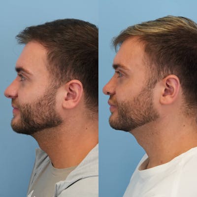Rhinoplasty Before & After Gallery - Patient 240119 - Image 6
