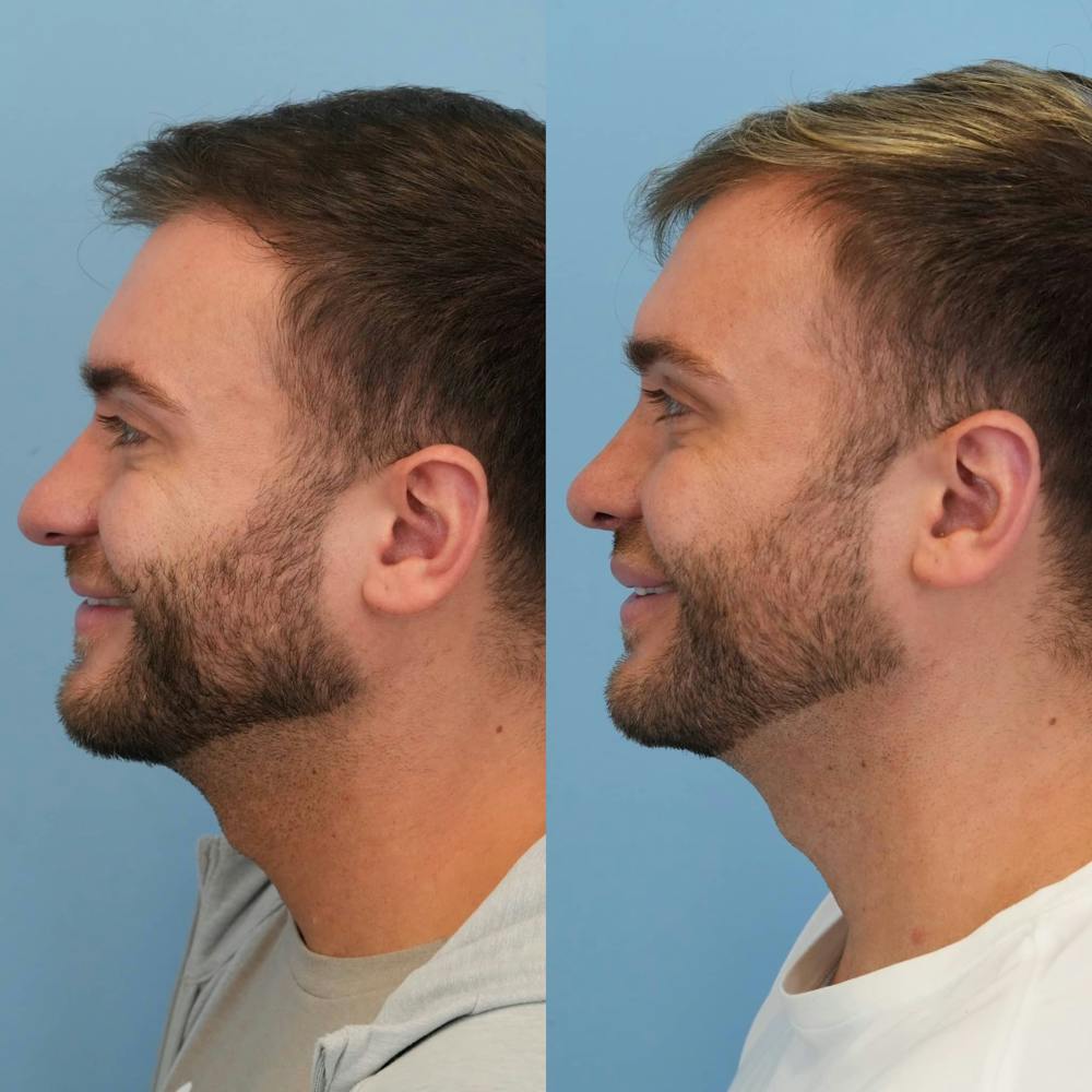 Rhinoplasty Before & After Gallery - Patient 240119 - Image 7