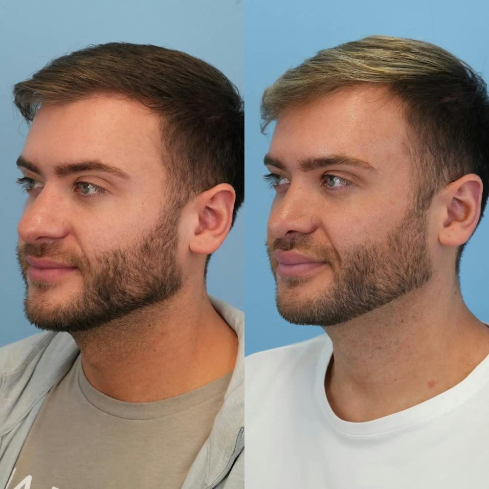 Rhinoplasty Before & After Gallery - Patient 240119 - Image 5