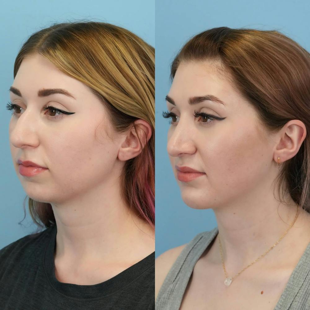 Rhinoplasty Before & After Gallery - Patient 372833 - Image 4