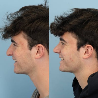 Rhinoplasty Before & After Gallery - Patient 173066 - Image 2