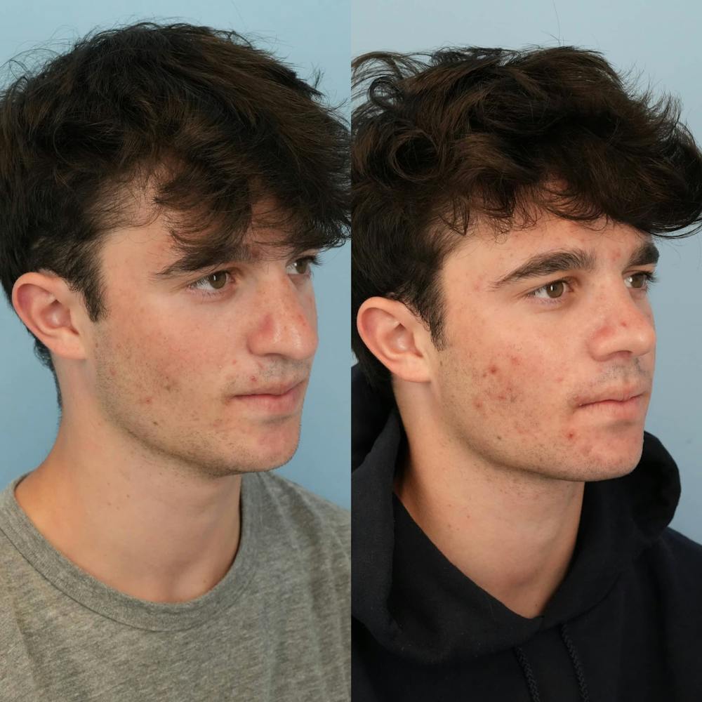 Rhinoplasty Before & After Gallery - Patient 173066 - Image 5