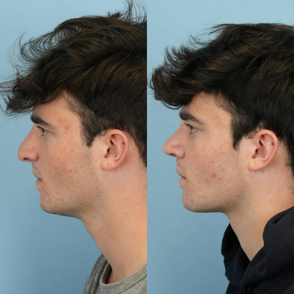 Rhinoplasty Before & After Gallery - Patient 173066 - Image 3